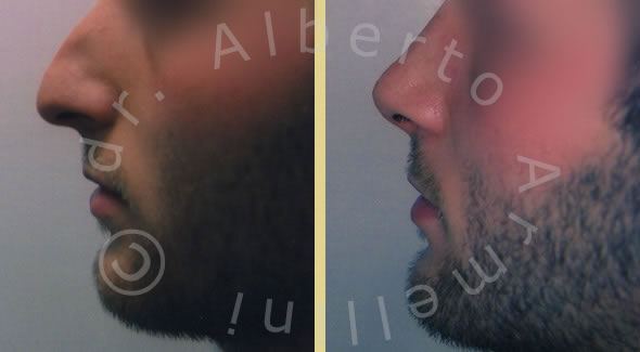 Rinoplastica conservativa con rimodellamento del dorso e della punta