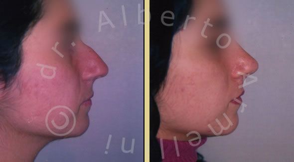 Rinoplastica conservativa con rimodellamento del dorso e della punta