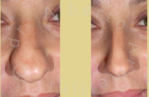 Rinoplastica conservativa con rimodellamento del dorso e della punta