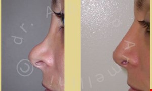 Rinoplastica secondaria: ricostruzione dorso e rimodellamento punta naso