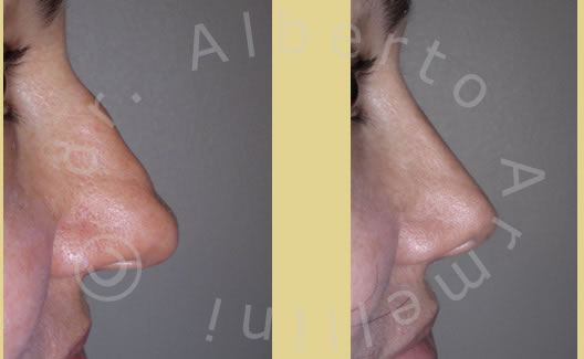 Rinoplastica conservativa con rimodellamento del dorso e della punta