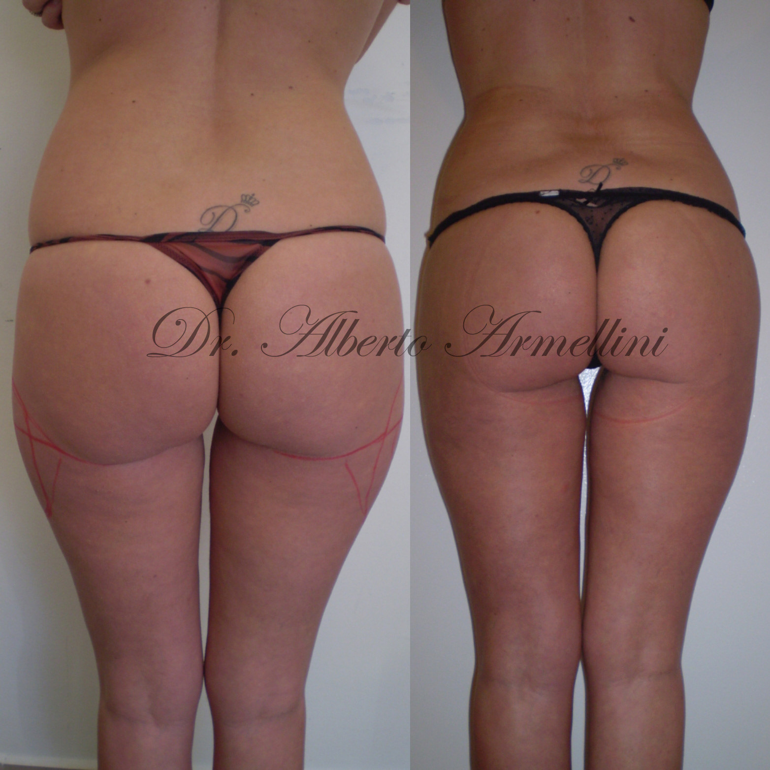 Liposcultura fianchi e trocanteri e lipostrutturazione regione glutea