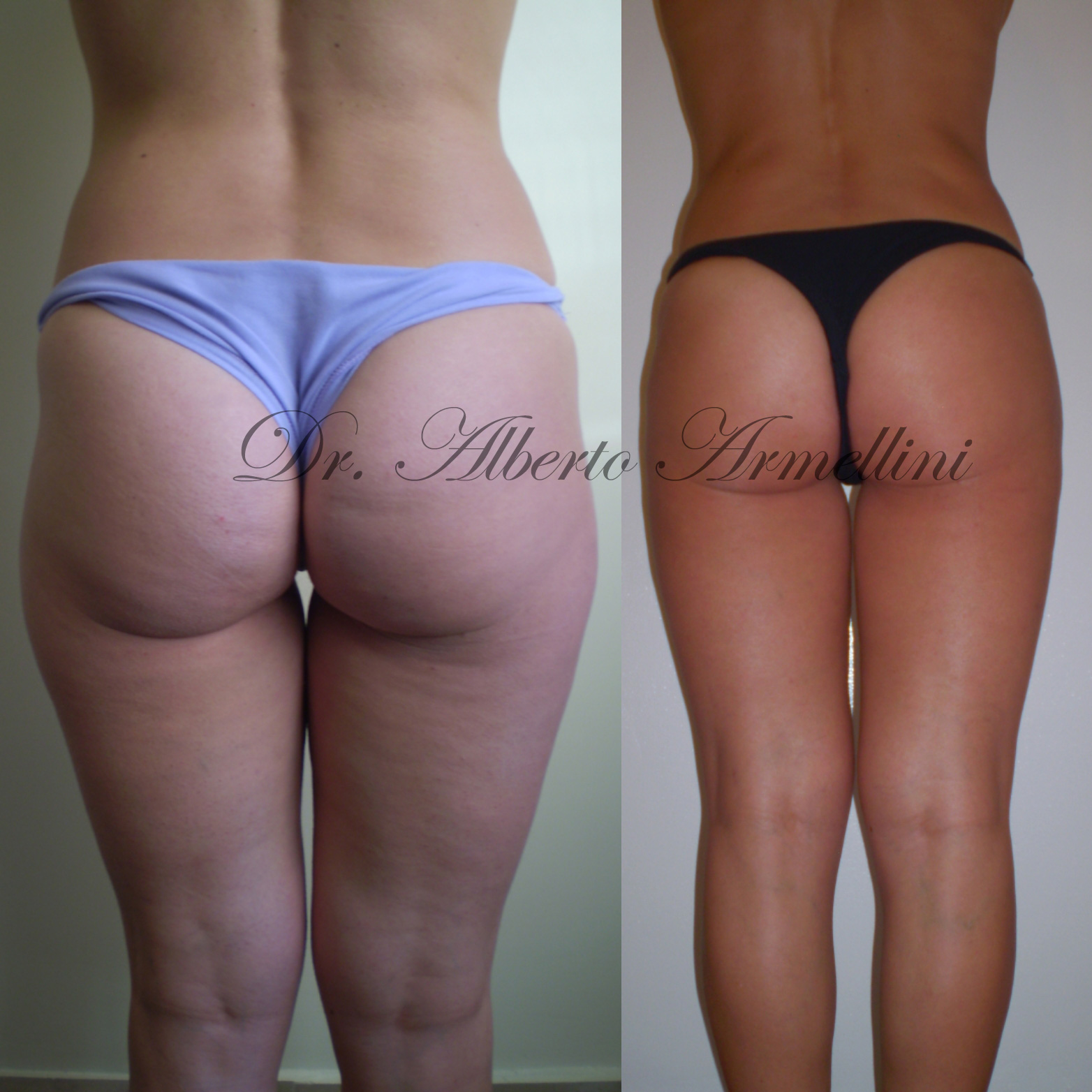 Liposcultura fianchi e trocanteri e lipostrutturazione regione glutea