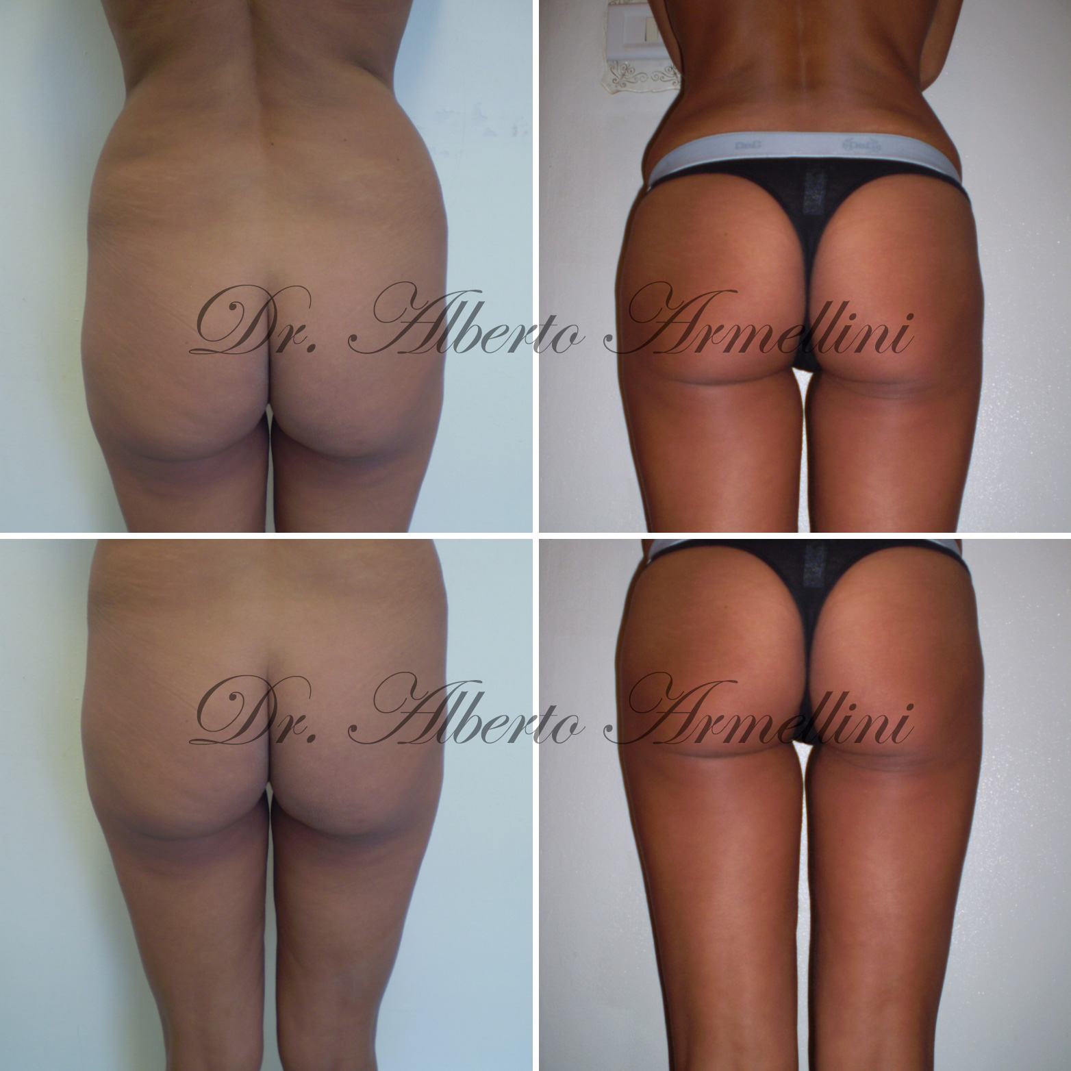 Liposcultura fianchi e trocanteri e lipostrutturazione regione glutea