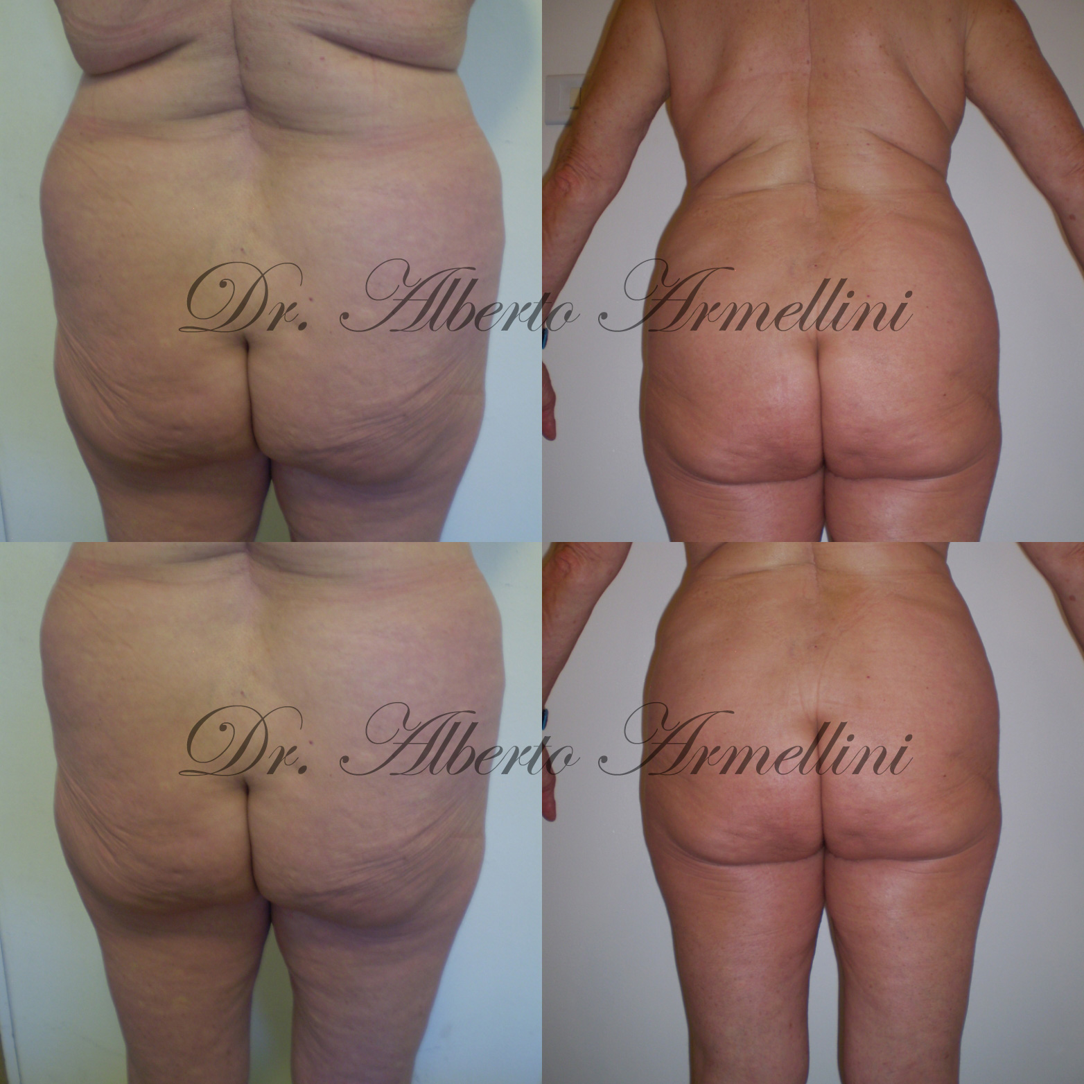 Paziente di 80 anni - Liposcultura fianchi e trocanteri e Lipostrutturazione regione glutea