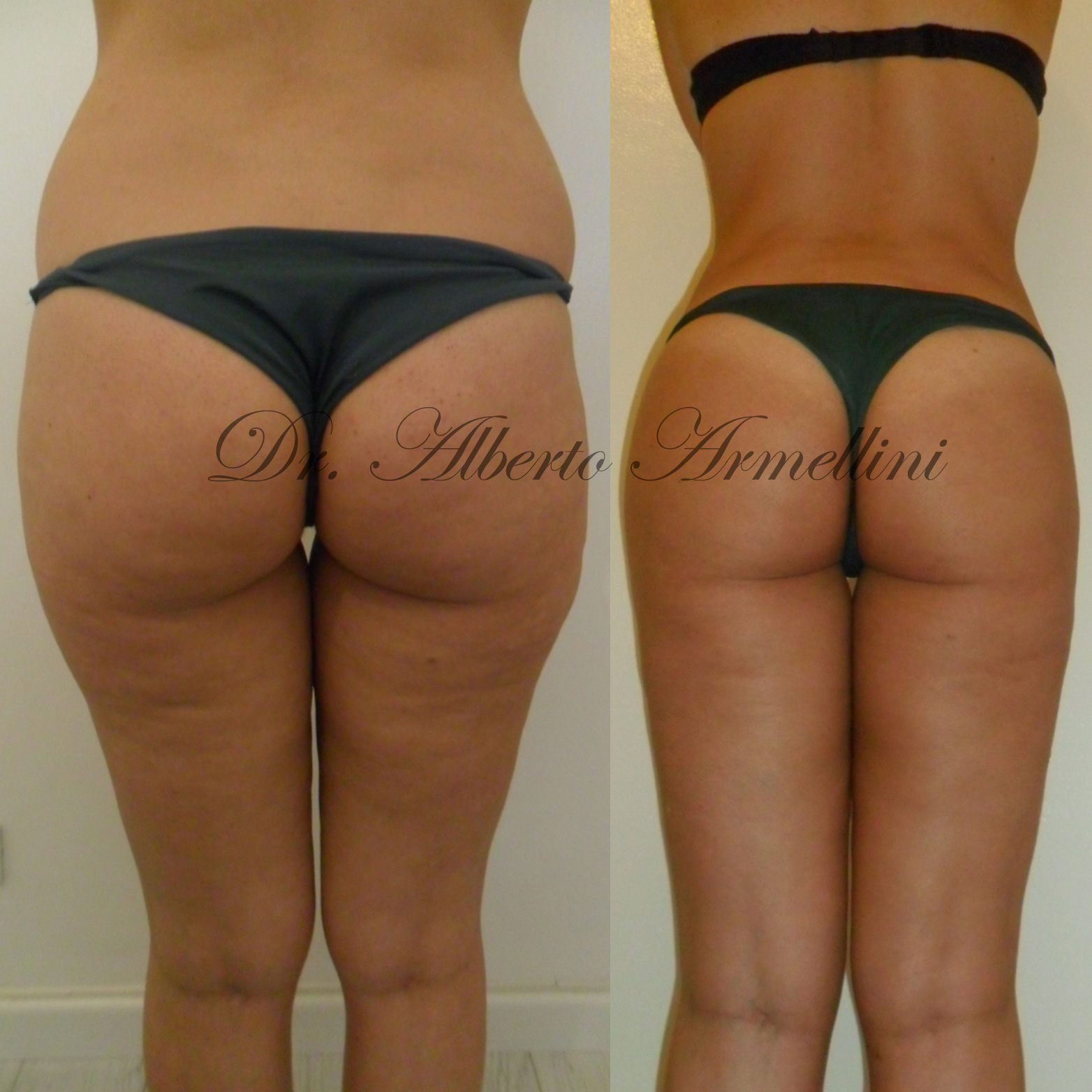 Liposcultura fianchi e trocanteri e lipostrutturazione regione glutea