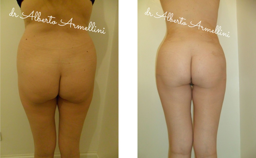 Liposcultura
