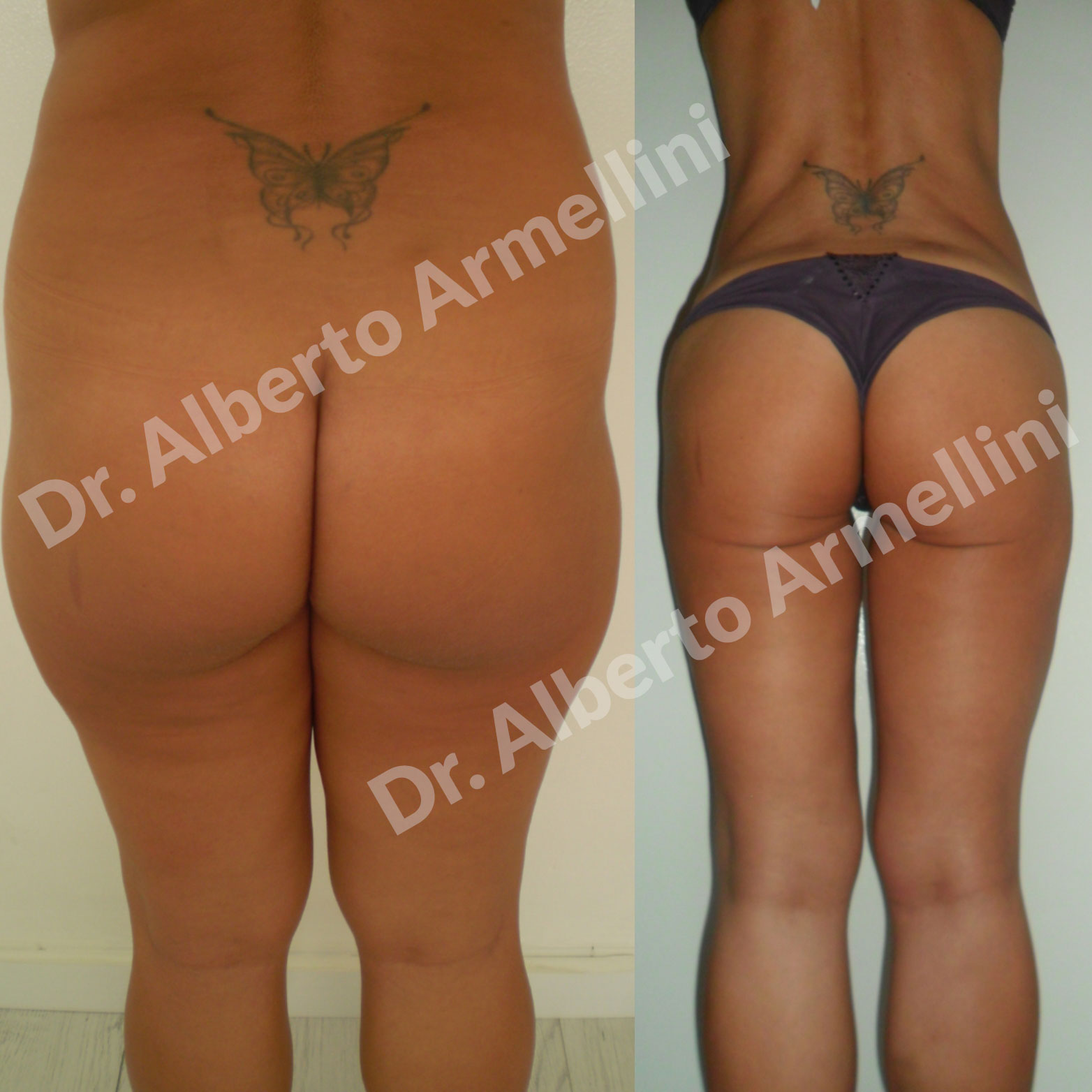 Liposcultura fianchi e trocanteri  e lipostrutturazione regione glutea