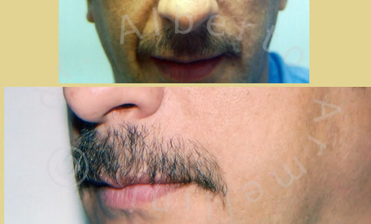 Somme Vertical Lifting della regione Malare