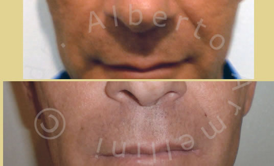 Somme Vertical Lifting della regione Malare