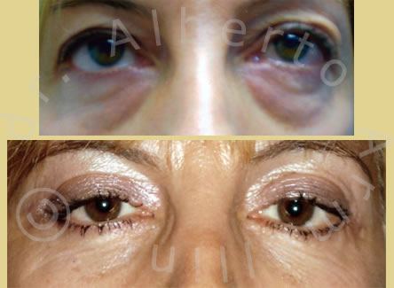 Blefaroplastica inferiore e Lifting 3D con protesi sottorbitarie