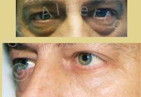 Blefaroplastica inferiore e Lifting 3D con protesi sottorbitarie