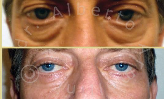 Blefaroplastica inferiore e Lifting 3D con protesi sottorbitarie