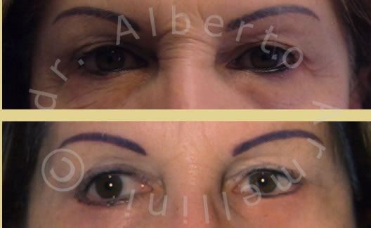 Blefaroplastica inferiore associata a Lifting regione glabellare