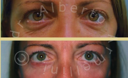 Blefaroplastica inferiore associata a Lifting regione glabellare