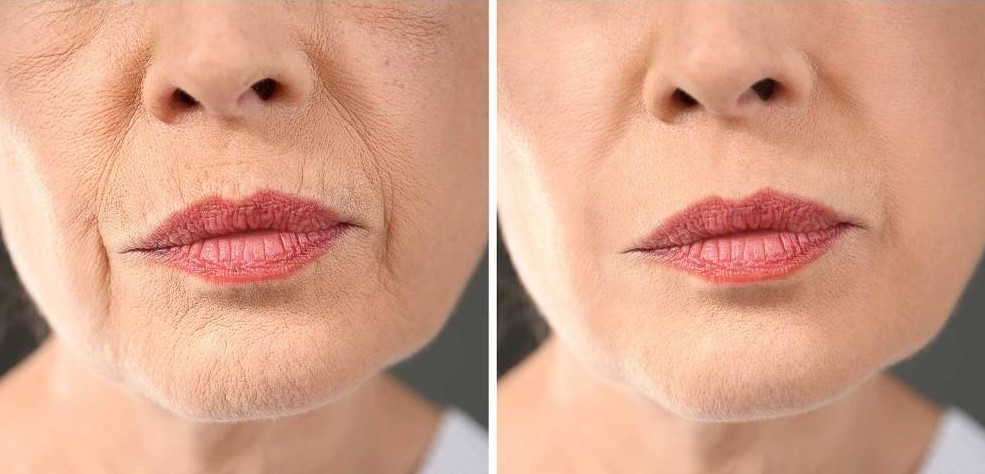 Filler per il viso: veloci e favolosi!